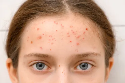 Аллергия на коже рук фотографии