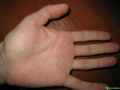 Аллергия на коже рук: макроизображение