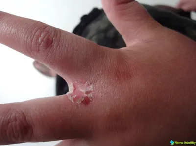 Изображение аллергии на коже рук: средний размер