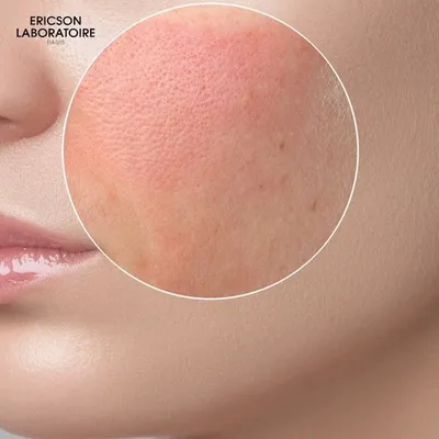 Аллергия на лице — от чего может быть, как проявляется, как избавиться