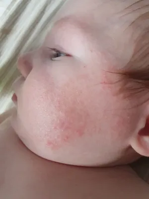 Аллергия? — 16 ответов | форум Babyblog
