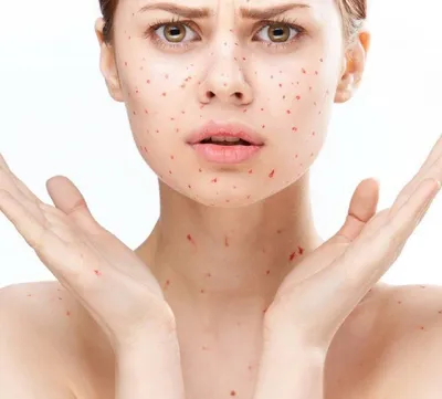 Аллергия на крем для лица: подбираем безопасную альтернативу | Woman.ru |  Дзен