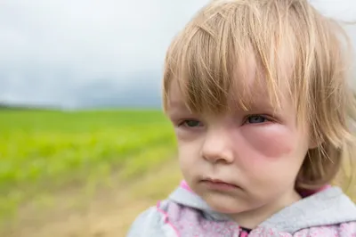 Прошу помощи или красные пятна на лице у дочки | Пикабу