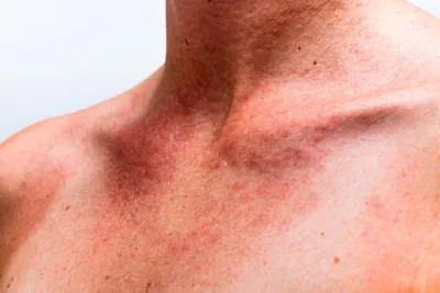 Аллергия на холод — как проявляются симптомы и как от нее избавиться