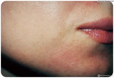 Что делать, если появилась аллергия на лице | Женский журнал Korolcat.ru |  Дзен