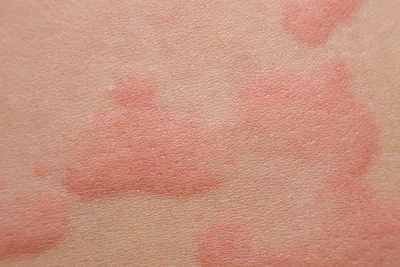 Сыпь у ребенка: причины, что делать при кожных высыпаниях | Heinz Baby