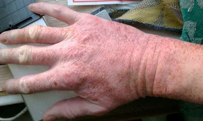 Фотография рук с симптомами аллергии на мороз
