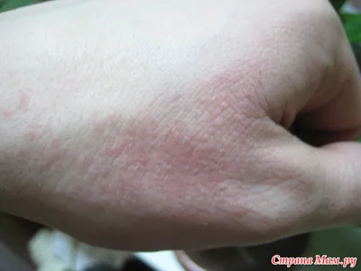 Фото рук с зудом и покраснением от аллергии на мороз: высокое разрешение