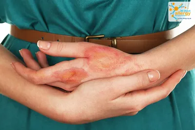 Изображение аллергии на пальцах рук в дневном свете