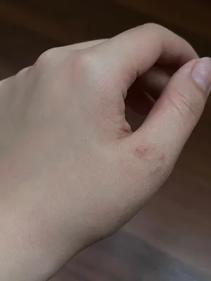 Изображение аллергии на пальцах рук на белом фоне