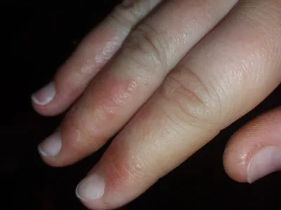 Изображение аллергии на пальцах рук в WebP формате
