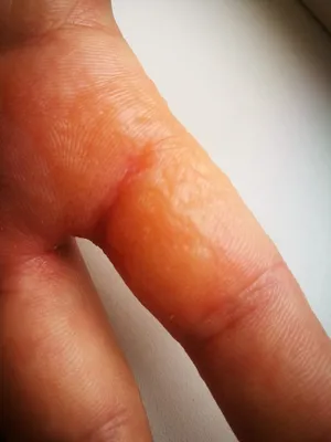 Фотография рук с аллергией на пальцах на фоне моря