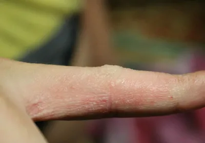 Картинка аллергии на пальцах рук с высоким разрешением