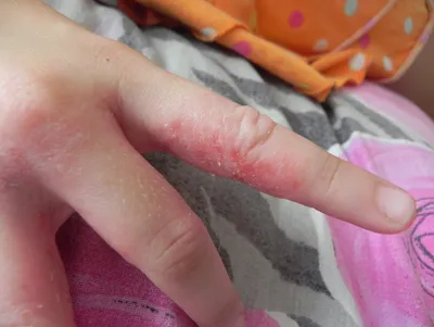 Фото аллергии на пальцах рук с макро-фокусом