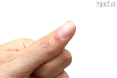 Фото с аллергией на пальцах рук в сепия-стиле