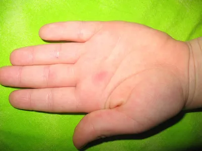 Фотографии аллергии на руках и ногах у малышей