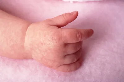 Фото аллергии на руках: как ее лечить