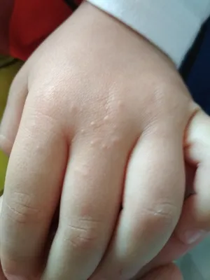 Размеры изображений аллергии на руках и ногах