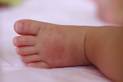 Аллергия на руках и ногах у ребенка: как выглядит на фото