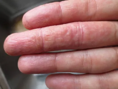 Изображения кожных высыпаний при аллергии на руках и ногах