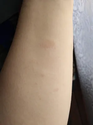 Фото аллергии на руках и ногах: что нужно знать о причинах