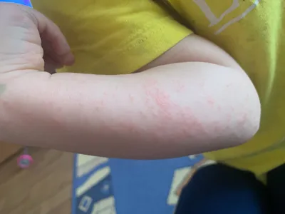 Изображения аллергии на руках: что нужно знать о противоаллергических средствах