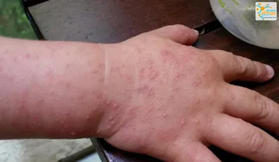 Аллергия на руках у ребенка фотографии