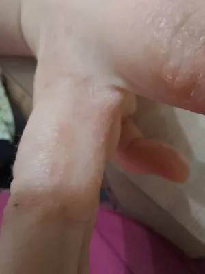 Фото аллергии на руках у ребенка: как защитить кожу?