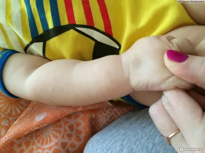 Аллергия на руках у ребенка: фотография для публикации в интернете