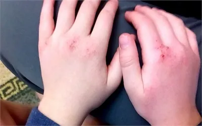 Аллергия на руках у ребенка: изображение в формате PNG