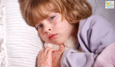 Аллергия на руках у ребенка: фотография высокого разрешения