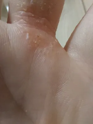 Фотография аллергии на руках у ребенка в формате JPG