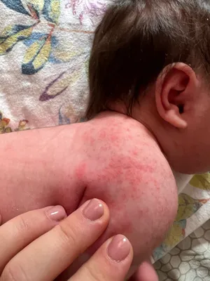 Фотография аллергии на руках у ребенка в высоком разрешении