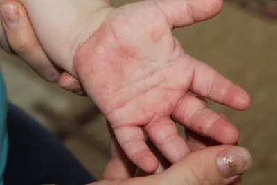 Картинка: аллергия на руках у ребенка