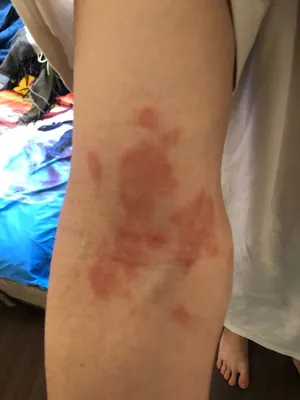 Изображение аллергии на руках у ребенка для медицинского использования