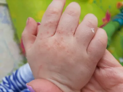 Изображение аллергии на руках у ребенка: причины и диагностика
