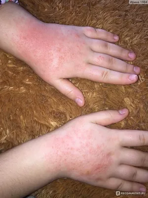 Изображение аллергии на руках: выберите формат для скачивания