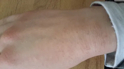 Изображение аллергии на руках: как диагностировать заболевание