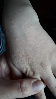 Фотография аллергии на руках: какие тесты нужно сдать