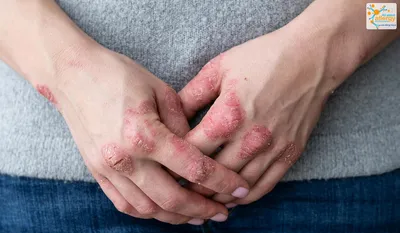 Фотография аллергии на руках: как определить симптомы