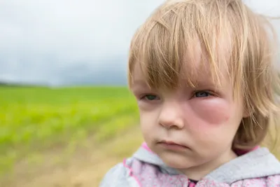 Аллергия на руках: картинка для скачивания