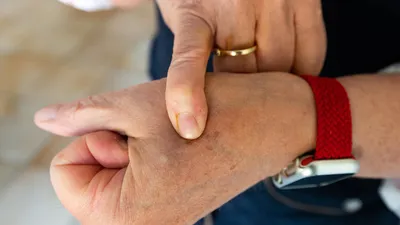 Руки с аллергией: изображение для медицинских целей