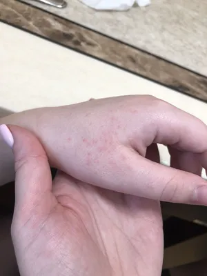 Фотка аллергии на руках: детальное изображение