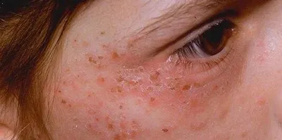 Аллергия на руках: фото для пациентов