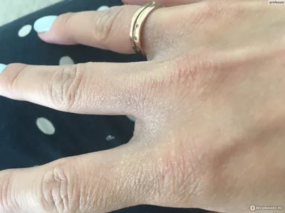 Фотография рук с аллергией: в высоком качестве