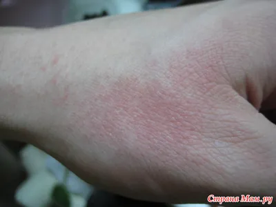 Руки с аллергией: изображение для документации