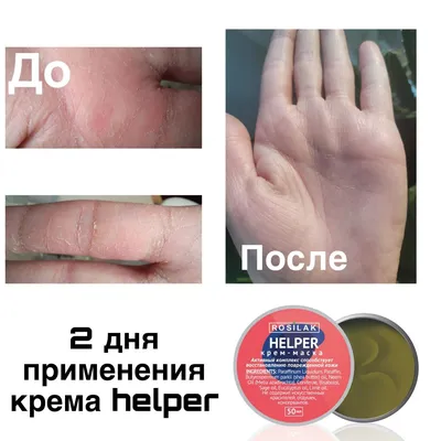 Фотография рук с аллергией: какие продукты следует избегать