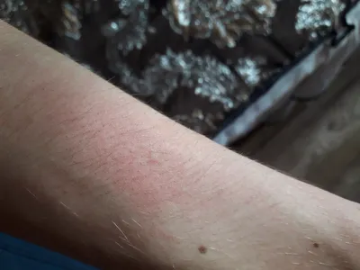 Фотография рук с аллергией на воду