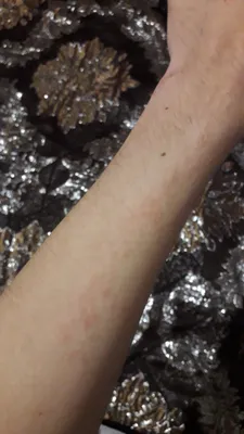 Картинка аллергии на воду на руках в формате PNG
