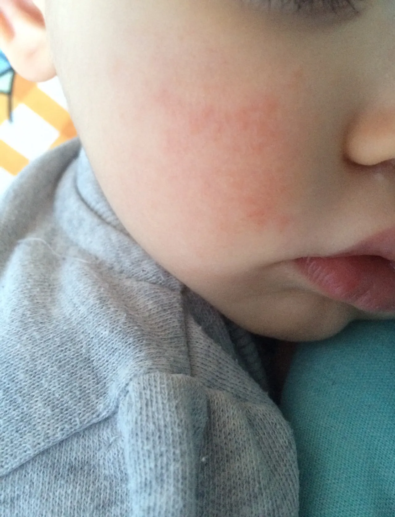 аллергия у детей фото описание